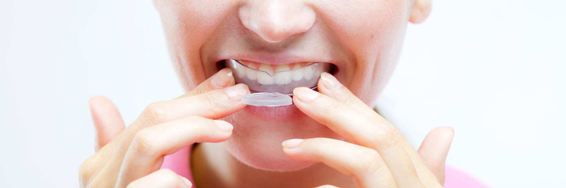 Nightguards for Sleep Apnea