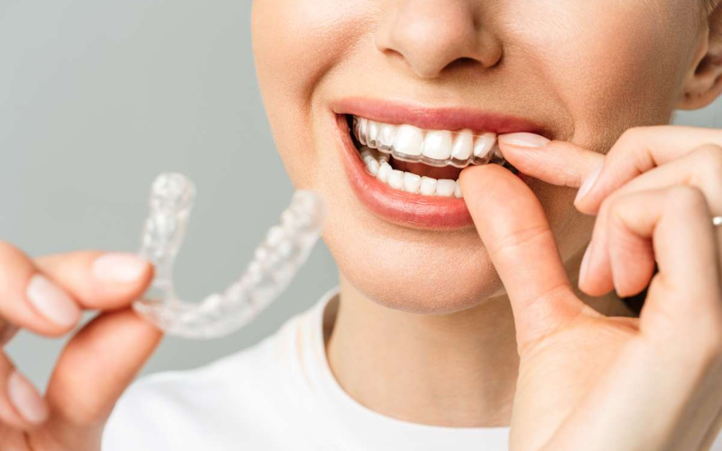 10 Reasons Adults Are Choosing Invisalign for Straighter Teeth