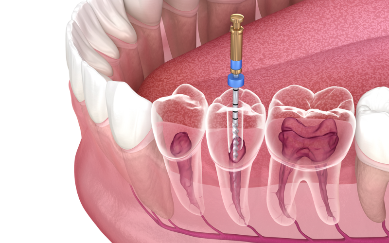 7 Common Signs You Need A Root Canal