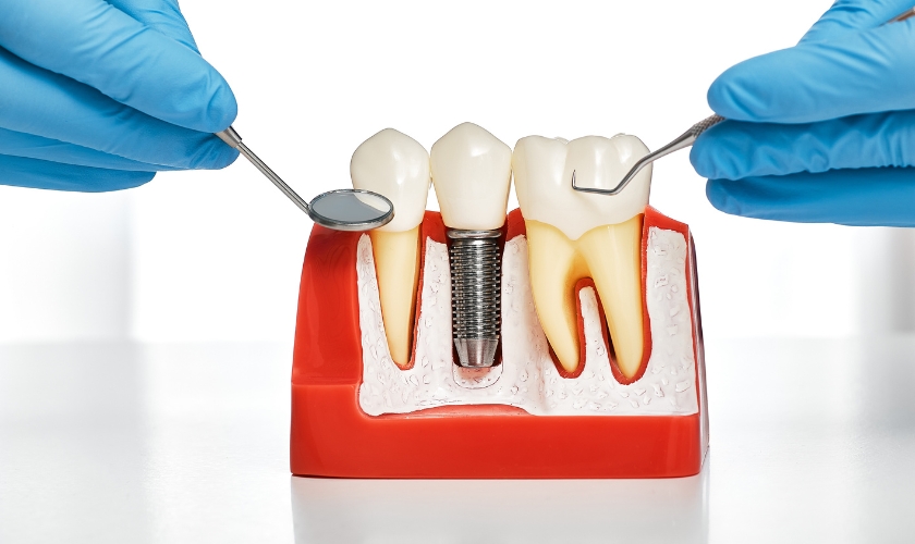 How Long Do Dental Implants Last?