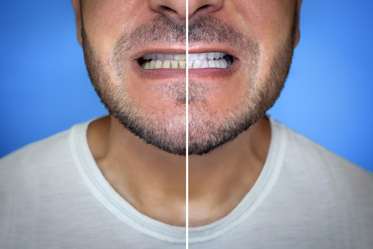 Teeth Whitening & Enamel Safety: What You Really Need to Know