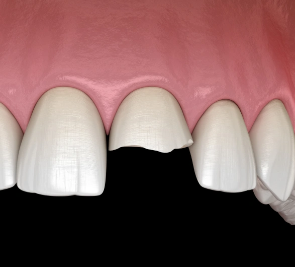 Chipped Tooth Repair