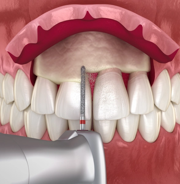Crown Lengthening
