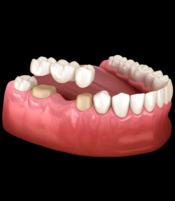 Dental Bridges