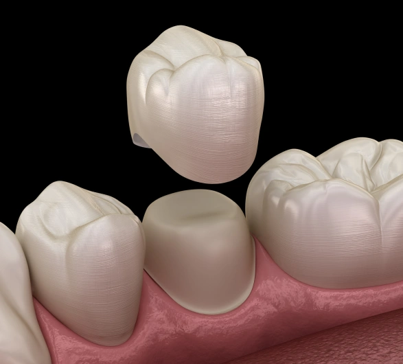 Dental Crowns