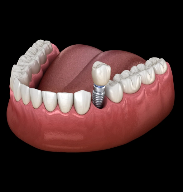 Dental Implants