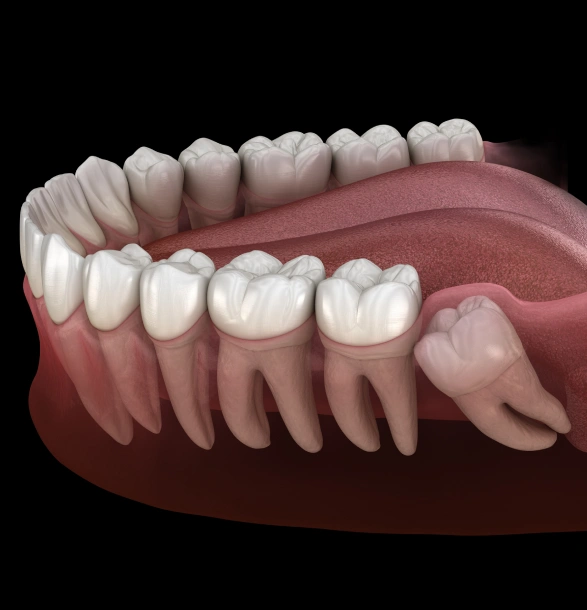 Wisdom Teeth Removal